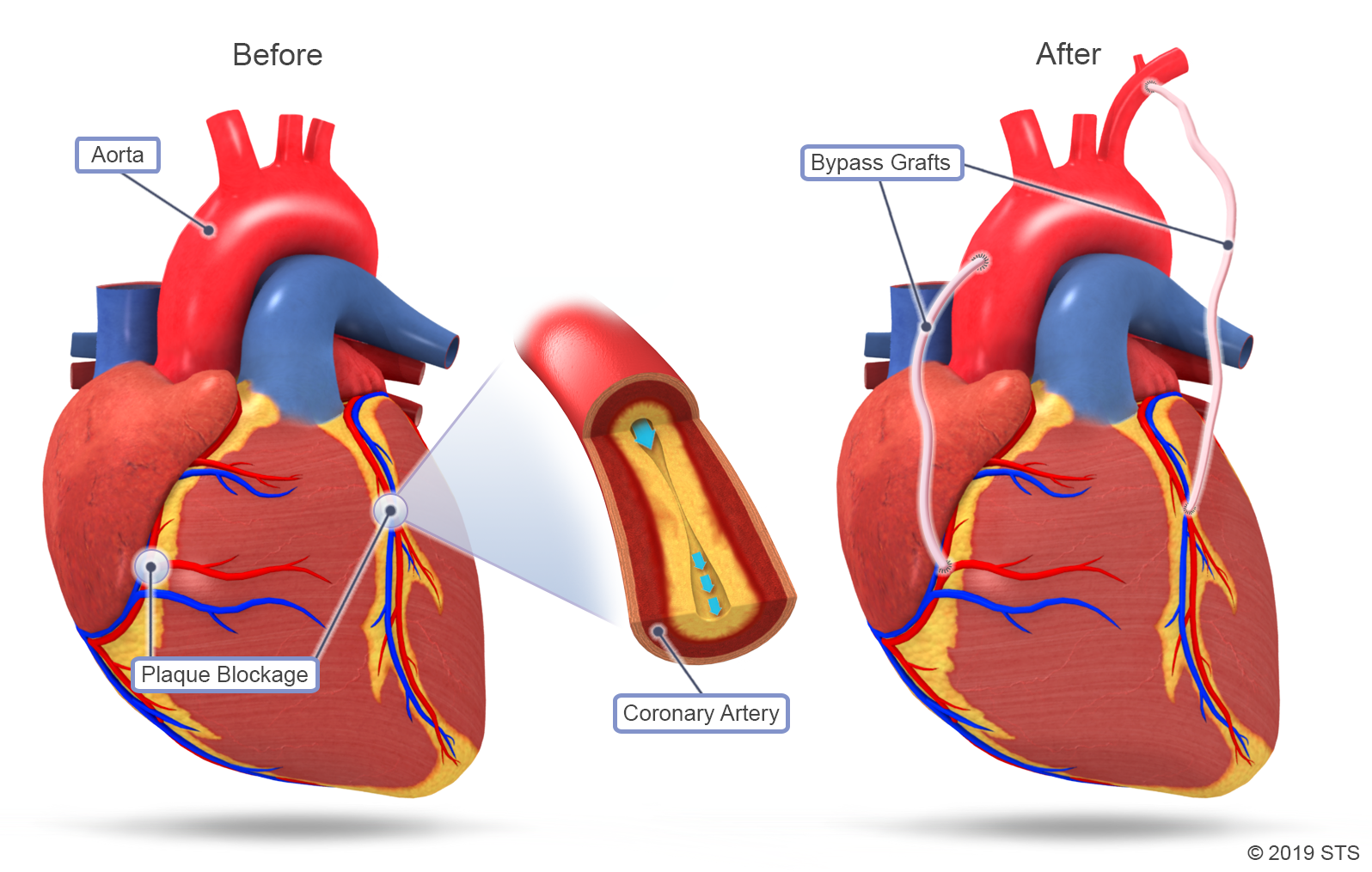 Coronary Artery Bypass Grafting (CABG) The Patient Guide to Heart